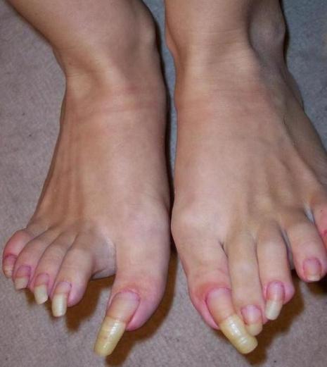 女性の長すぎる足の爪